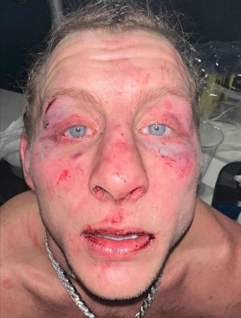 Пэдди Пимблетт после боя с Джастином Гейджи — лицо превратилось в фарш!